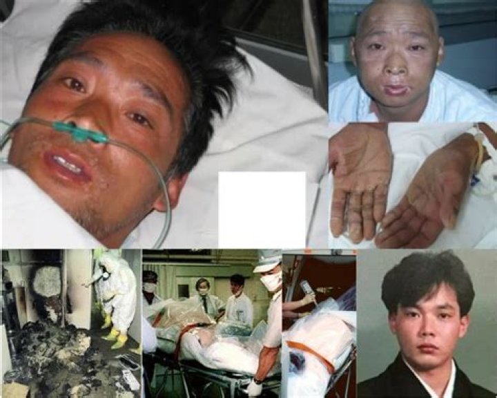 Hisashi Ouchi's True Picture: An Unforgettable Look At Radiation's Devastating Effects