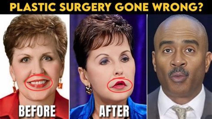 Surprising Joyce Meyer Plastic Surgery Transformation